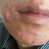 痤疮的物理治疗和其他治疗是怎样的呢