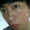 痤疮的药物治疗办法有什么呢