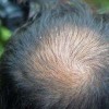 斑秃中医治疗的4个必须多加注意