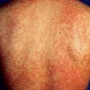 红皮病常见的危害是什么