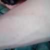 疥疮在患病早期常见症状有什么
