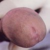 患淋病后有哪些需要注意