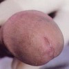 淋病生活中注意什么