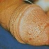 得了淋病要如何进行护理