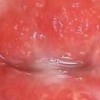 淋病患者饮食需注意的问题