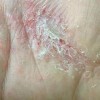 手指汗疱疹早期的症状都有什么呢