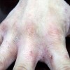 疥疮的预防措施是什么