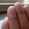 怎样预防汗疱疹办法有什么