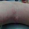 疥疮患者日常护理千万注意