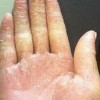 怎样的预防汗疱疹复发