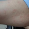 疥疮治疗不及时会出现什么