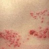 疱疹患者需都要什么检查