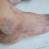 脚气患者应避免频繁的发作
