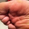 脚气是哪些因素会致使