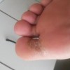 脚气发病的原因都是什么