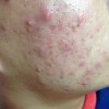 痤疮患者的家庭护理怎么做好   如何从原因进行预防