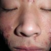 痤疮的诱发原因一般是哪些呢