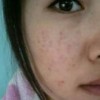 痤疮是什么情况