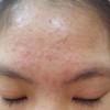 痤疮是怎么形成的 细菌感染是主要原因