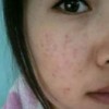 痤疮产生的原因都有什么呢