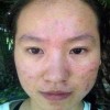 痤疮到底是如何产生的