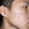 不同部位长痤疮的原因分别是什么