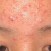 痤疮的致病因素以及临床症状