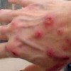 疥疮患者个人千万注意