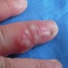 预防汗疱疹的八大注意细节