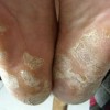 水疱型脚气产生的原因