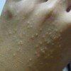 手足汗疱疹涂什么药膏
