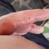 起了汗疱疹但不疼不痒正常吗