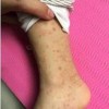 过敏性紫癜对患者有什么危害