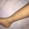过敏性紫癜肾炎有什么伤害