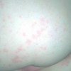 单纯疱疹的临床病症表现
