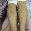 过敏性紫癜多发