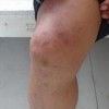 对过敏性紫癜是什么的解释