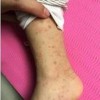 过敏性紫癜肾炎可以生育吗