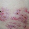 男性生殖性疱疹临床症状有哪些