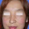 如何去除遗传性雀斑
