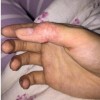 手上起汗疱疹传染吗