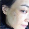 清除脸上雀斑的小方法