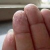 汗疱疹用什么洗手