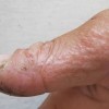 汗疱疹患者饮食应该注意什么