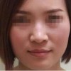 激光去雀斑会不会反弹