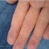 汗疱疹和手足癣的鉴别诊断是什么