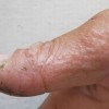 真菌会引起的汗疱疹吗