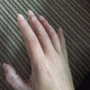 汗疱疹的治疗办法有什么