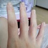 无极膏治汗疱疹好吗