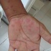 过敏性紫癜患者应该怎样吃